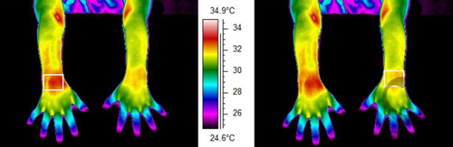 腕部的红外热像图